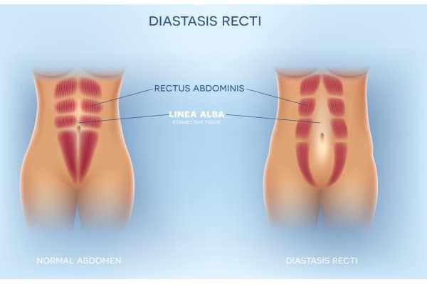 What Non-Surgical Options Are Available for Diastasis Recti Govan?