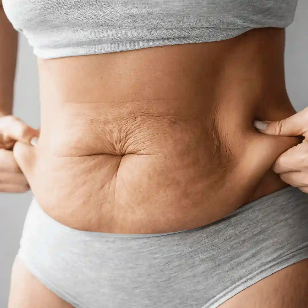 Is It Normal to Have Loose Skin After Pregnancy Govan?